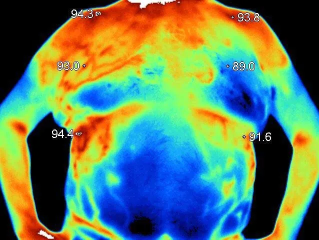 Thermogram displaying significantly warm areas over the right chest and rib cage. CT scan revealed a lung tumor in the right lower lobe, 7cm x 5cm.
