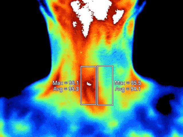 Thermogram showing a thyroid nodule on the right side of the neck