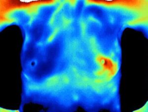 Thermogram revealing an abnormality in the left breast
