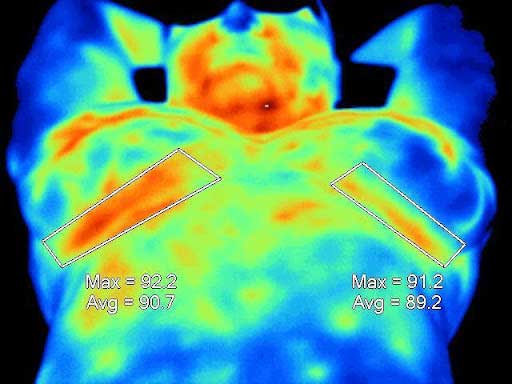 This thermogram shows inflammation from an underwire bra