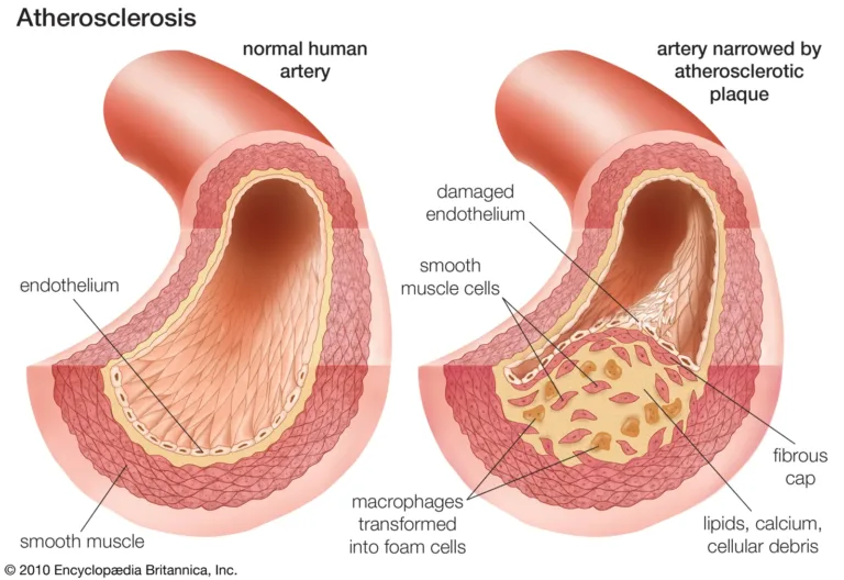diagram of normal vs unhealthy artery