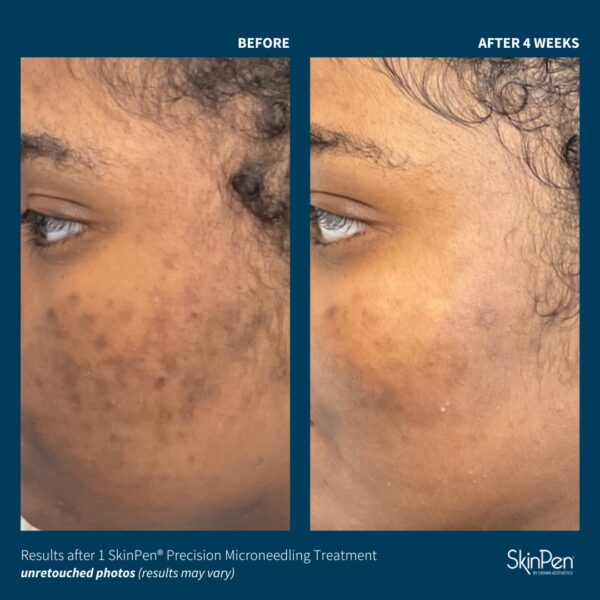 SkinPen® Microneedling - Image 5