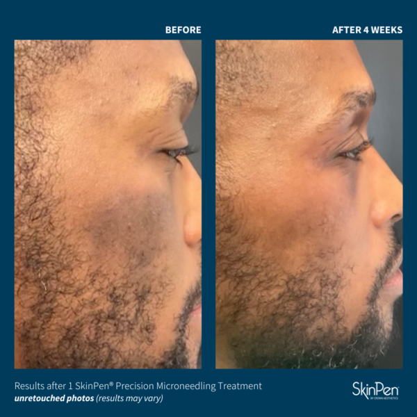 SkinPen® Microneedling - Image 9