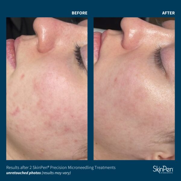 SkinPen® Microneedling - Image 3