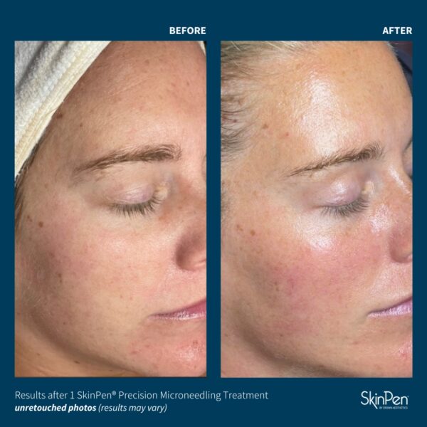SkinPen® Microneedling - Image 2