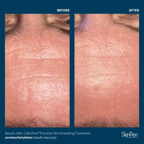 SkinPen® Microneedling - Image 4