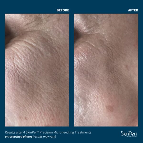 SkinPen® Microneedling - Image 8
