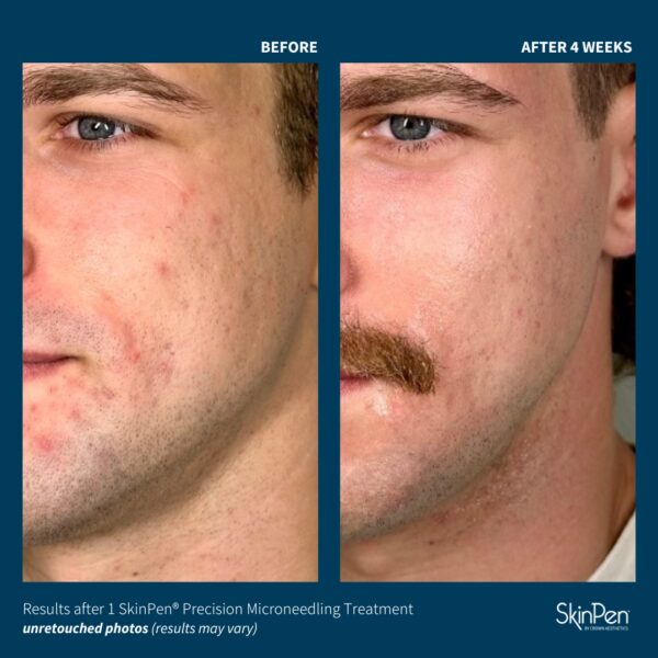 SkinPen® Microneedling - Image 7