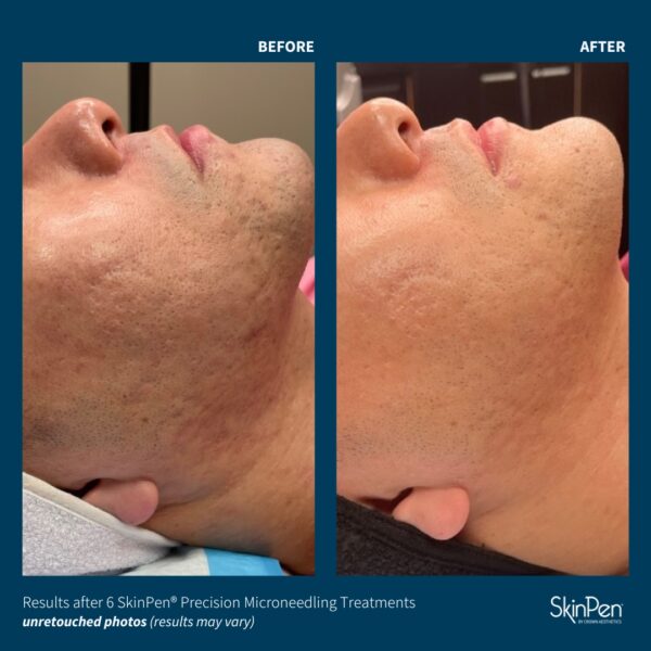 SkinPen® Microneedling - Image 6